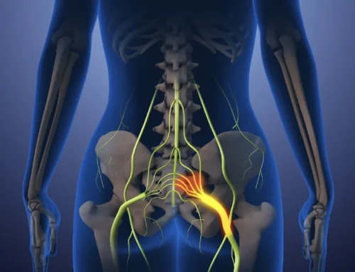 Robotic Therapy: Sciatica Pain Relief in Michigan